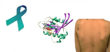 Neurofibromatosis Nedir?