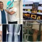 En Ucuz Uzatma Cerrahisi- Cheapest Limb Lengthening Surgery